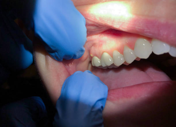 Best Emergency Dental Care for Broken or Chipped Teeth in Conroe, TX
